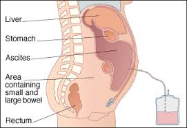 ASCITES