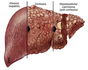 liver cirrhosis ayurvedic drops savliv drops for cirrhosis